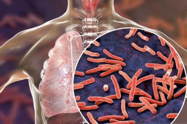 Capaian Penanganan TBC di Bali Belum Optimal, Selama 4 Bulan Ditemukan 1.252 Kasus