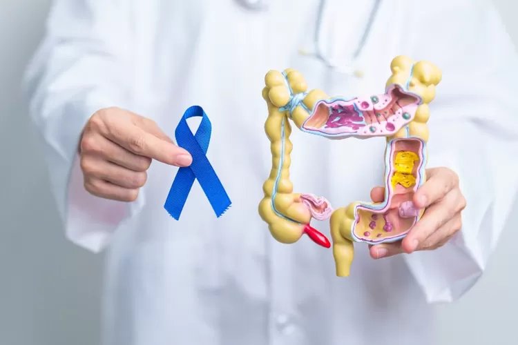 Dilengkapi Pusat Onkologi, Penanganan Kanker Kolorektal Tingkat Lanjut di Mayapada Hospital