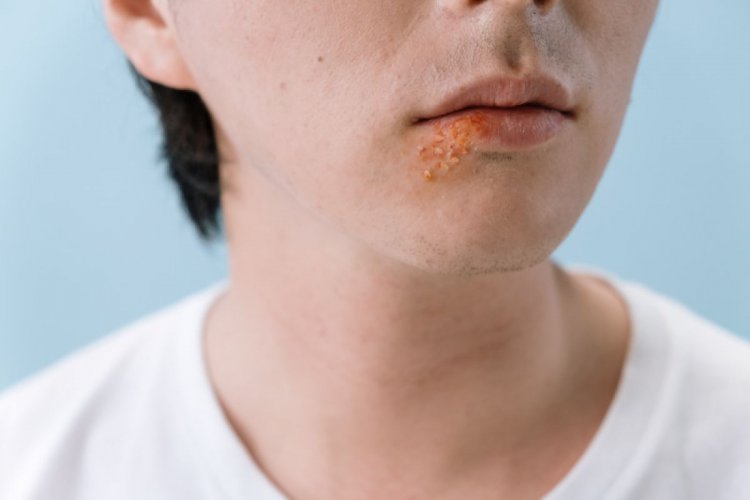 Vaksin herpes zoster beri efek jangka panjang pada kesehatan jantung