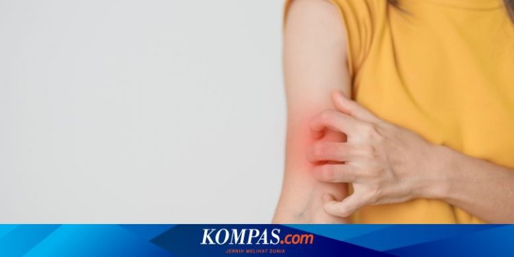 4 Faktor Penyebab Lupus yang Harus Diketahui: Ada Genetik dan Lingkungan