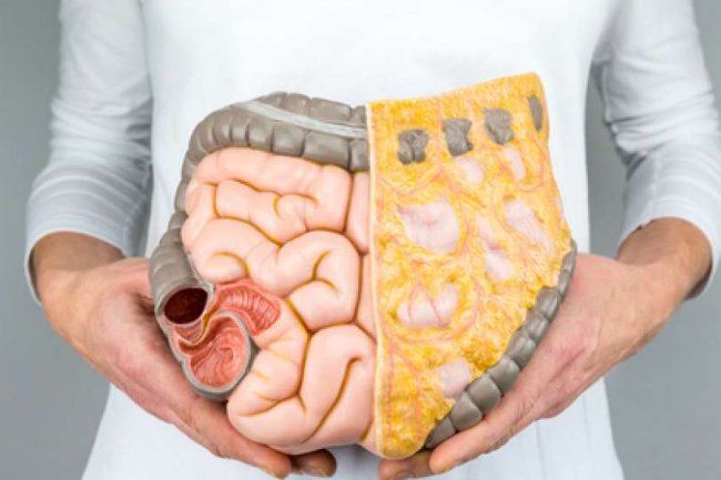 Lonjakan Kasus Radang Usus Kronik di Indonesia: Penyebab Pasien Baru Sadar saat Parah