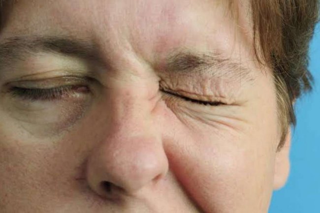 Bell's Palsy, Kelumpuhan Sementara Syaraf di Wajah yang Bikin Tidak Nyaman