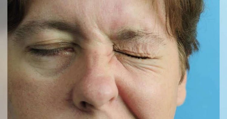 Bell's Palsy, Kelumpuhan Sementara Syaraf di Wajah yang Bikin Tidak Nyaman