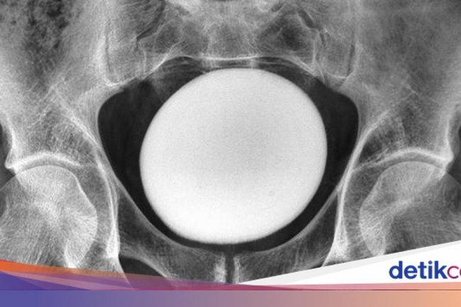 Dokter Temukan Batu Kemih Raksasa di Tubuh Pasien, Ukurannya Mirip Telur Burung Unta