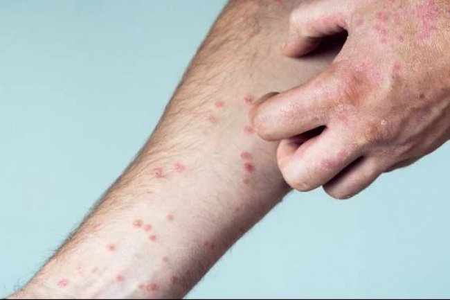 Anak Terkena Cacar Air Jangan Takut Mandi, IDAI Ungkap Manfaatnya