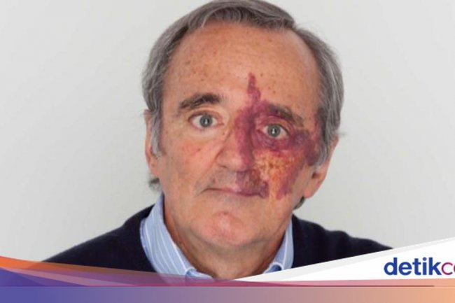 Dr Mariano Barbacid Jadi Sorotan, Ini Studinya yang 'Musnahkan' Kanker Pankreas