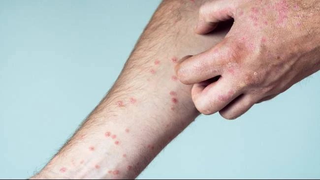 Anak Terkena Cacar Air Jangan Takut Mandi, IDAI Ungkap Manfaatnya