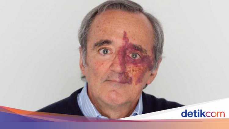 Dr Mariano Barbacid Jadi Sorotan, Ini Studinya yang 'Musnahkan' Kanker Pankreas