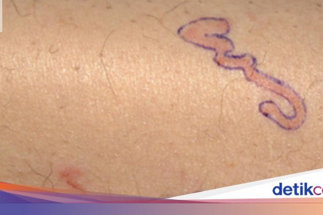 Pria Heran Ruam Kulitnya 'Bergerak', Rupanya Ada Cacing yang Merayap