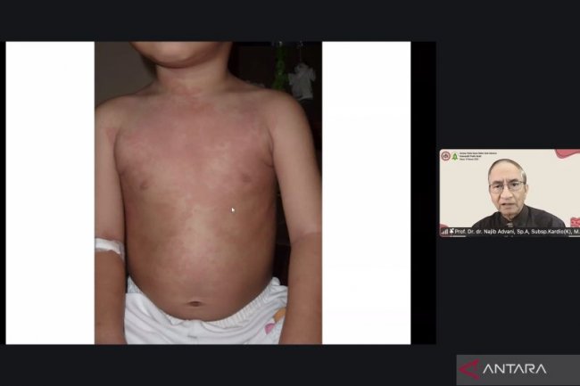 Ribuan Kasus Kawasaki di Indonesia Diduga Belum Terdiagnosis