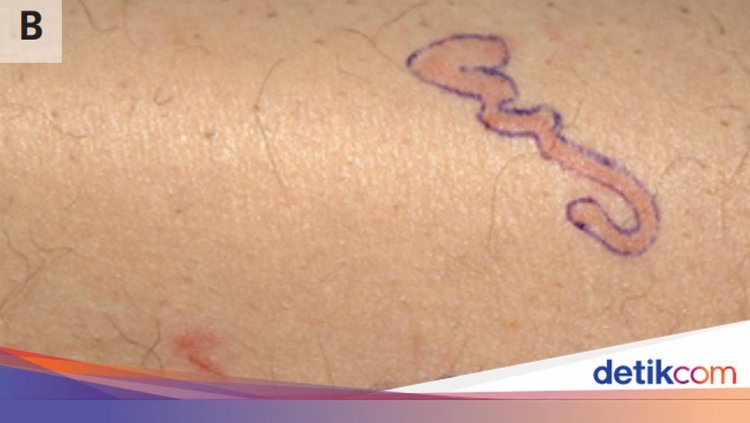 Pria Heran Ruam Kulitnya 'Bergerak', Rupanya Ada Cacing yang Merayap