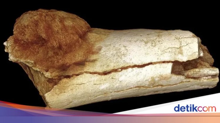 Fosil Purba Berusia 1,7 Juta Tahun Ungkap Manusia Pertama yang Kena Kanker